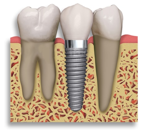 implant dentaire